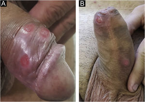 (A and B), Multiple hard chancres may occur in up to 25% of cases but are more commonly found in HIV-infected patients.