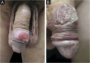 (A), When the lesions are larger than two centimeters in diameter, they are called giant chancres. (B), When destructive, they are called phagedenic chancres, often associated with superinfection by associated bacteria.