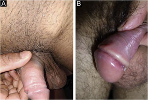 (A), Regional lymphadenopathy accompanies cases of hard chancre. They comprise multiple lymph nodes with a larger one: the “mayor node”. (B), Cord-like lesions may mimic Mondor