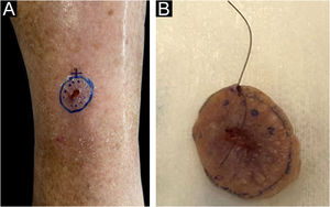 (A), Clinical aspect of the lesion before excision with dermoscopic delimitation of the surgical margins. (B), Sample resected and identified with surgical thread by the surgeon; reference point at the 12 o’clock position.