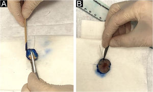 (A), The peripheral and deep margins of the specimen are painted by the pathologist. (B), Excision of the peripheral margin of the specimen, to be sent for the preparation of the frozen sections, consists of a 2.0 to 3.0 mm thick specimen obtained at the reference point with an incision parallel to the peripheral margin.
