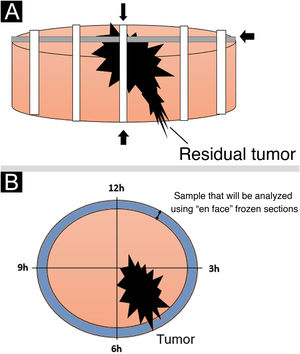 (A), Schematic drawing demonstrating the standard freezing technique: the sample is sectioned by removing transverse strips at right angles to each other. (B), The “en face” freezing technique is demonstrated, which examines all peripheral and deep margins of the lesion.