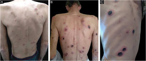 Clinical aspect of the lesions (A) initial erythematous-squamous papules, (B) ulcerated plaques on the trunk (C) lesions covered with rupioid crusts at higher magnification.
