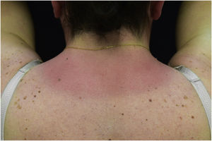 Photosensitive rash induced by nivolumab | Anais Brasileiros de ...