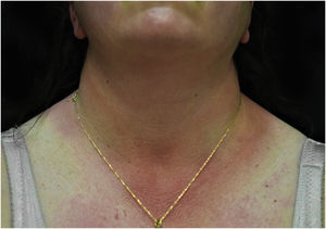 Erythematous rash located in photo-exposed areas: neckline.