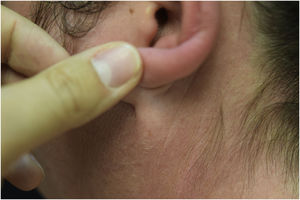 Erythematous rash located in photo-exposed areas: earlobe fold is respected.