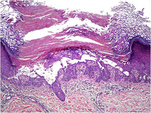 Light microscopy shows hyperkeratosis, suprabasal clefting, and dyskeratotic cells. There is a mild lymphocytic infiltrate in the papillary dermis (Hematoxylin & eosin, ×100).