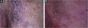 Dermatoscopic examination (×10). (A), Before acitretin treatment. Big comedo-like openings (300 to 500 microns) with a central hyperkeratotic structure, surrounded by a whitish scaling halo. (B), After acitretin treatment. Few white shiny clods with a pinkish homogeneous background.