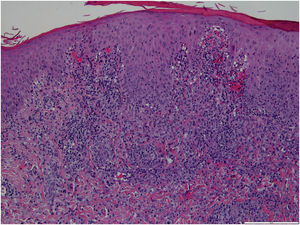 Multifocal dermal infiltrate of small lymphocytes, some plasma cells and histiocytes, as well as several lymphoid cells with amphophilic cytoplasm and big nucleus with prominent nucleolus (Hematoxylin & eosin, ×100).