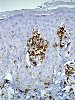 Hyperchromic plaques with ichthyosiform desquamation on the anterior trunk region.