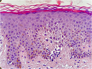 Orthokeratotic hyperkeratosis hypogranulosis and exocytosis of atypical lymphocytes (Hematoxylin & eosin, ×40).
