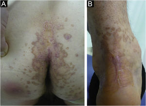 Well-defined brownish plaques of porokeratosis on the buttock (a) and Achilles tendon (b).