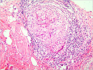 Hematoxylin & eosin, ×400. A granuloma with caseous necrosis and lymphocytic infiltration.
