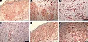 Immunohistochemical reactions: A: nestin (20X), B: nestin (40X), C: endoglin (40X), D: endoglin (40X), E: VEGF-C (20X), F: VEGF-C (40X). The chromogen used was 3-amino-9-etilcarbazol (AEC).
