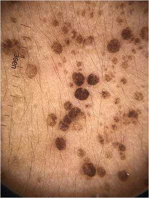 Dermoscopy showing brownish, crypt-like structures.