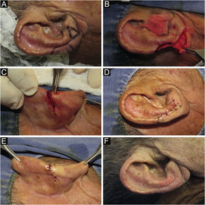 (A) Clinical lesion and margin delimitation. Design of the flap, with a compensation triangle at the level of the auricular lobe. (B) Composite surgical defect (skin and cartilage) and linear incision on the anterior surface of the ear. (C) Posterior view of the advancement movement, after resection of the retroauricular compensation triangle. (D‒E) Suture by planes and immediate postoperative period. (F) Late postoperative period.