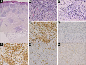 Histological features showed infiltration of inflammatory cells mainly in the epidermis and around blood vessels and sweat glands in the dermis (a). In the epidermis, inflammatory cells were lymphocytes (b). Around blood vessels in the dermis, inflammatory cells were lymphocytes and eosinophils (c) (Hematoxylin & eosin, a ×50; b ×400; c ×400). Immunohistochemistry revealed intense expression of CD3 (d) and CD4 (f), and little expression of CD20 (e), CD8 (g) and CD30 (h) in the infiltrating lymphocytes in the epidermis (original magnification: d–h; ×400).