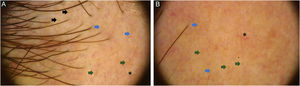 Diffuse erythemato-whitish background, with empty hair follicles (black arrow), yellow-orange dots (green arrow), pigmented thin hairs (blue arrows) and fine linear branching vessels (*).