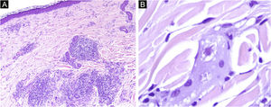 (a) Dermal lymphoplasmacytic infiltrate and granulomatous infiltrate with interstitial multinucleated giant cells. (b) Giant cell with intracitoplasmatic asteroid bodies. (a ‒ Hematoxylin & eosin, ×40; b ‒ Hematoxylin & eosin, ×400).