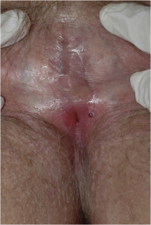 Advanced lichen sclerosus. Complete fusion of labia mayora.