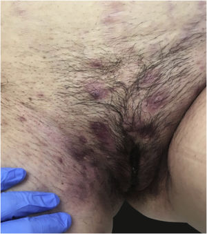 Hidradenitis suppurativa.