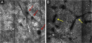RCM of the basal layer. (A and B) Cobblestone pattern, characterized by sets of white shiny and small round structures representing the pigmented basal keratinocytes. Dark round structures represent the hair follicles (red arrows) and dark linear fissures representing the invaginations of the skin (yellow arrows).