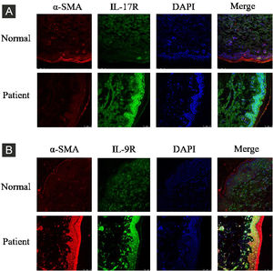 IL-17R and IL-9R were highly expressed in skin tissues of SSc patients. A, Compared to healthy control, IL-17R was highly expressed in the skin tissue of SSc patients. α-SMA, red fluorescence, 1:200. IL-17R, green fluorescence, 1:200. B, Compared to healthy control, IL-9R was highly expressed in the skin tissue of SSc patients. α-SMA, red fluorescence, 1:200. IL-9R, green fluorescence, 1:200.