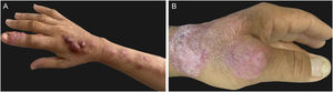 Clinical forms of human sporotrichosis. (A) Lymphocutaneous – inoculation chancre in the index finger and skin lesions in the ascending regional lymphatic pathway. (B) Fixed cutaneous form – verrucous lesion on the dorsum of the hand.