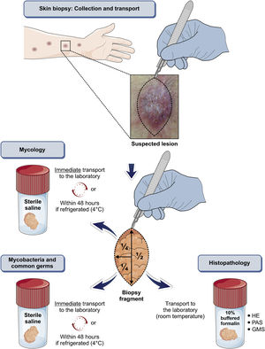 Flowchart for the collection and transportation of material sampled by biopsy, for the diagnosis of human sporotrichosis. The illustration was partially based on Servier Medical Art elements, licensed by Creative Commons Attribution 3.0 Unported License.