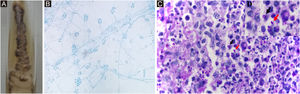 Sporothrix ssp. (A) Macromorphological aspect of the colony on Mycosel agar, at room temperature. It has a membranous surface, with a pearly luster, whitish color, surrounded by a blackened halo. (B) Colony micromorphology, at room temperature, shows delicate, branched, septate hyaline hyphae and oval or rounded conidia in a “daisy” arrangement, at the conidiophore tip. Cotton blue stain, ×100. (C) Histopathological skin section showing suppurative granuloma and parasitic fungus. Epithelioid cells on the left, neutrophils and pyocytes on the right, round yeast-like (black arrow) and elongated or navicular fungal cells (red arrow) PAS, ×1000. (D) Detail of fungal cells.