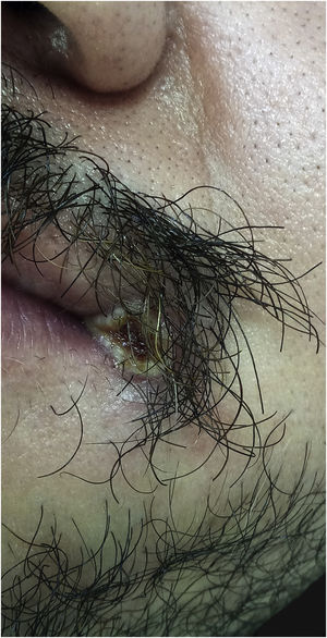 Monkeypox. Pustule with a depressed and necrotic center located at the left labial angle.