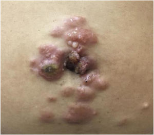 Multiple purplish-brown nodules with an ulceronecrotic surface in the umbilicus and periumbilical region.