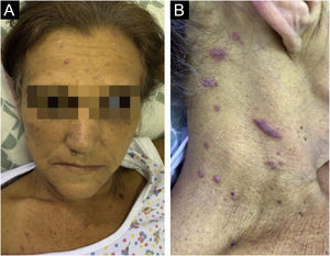 (A) Jaundice and erythematous papules on the face. (B) Violaceous papules with slight desquamation and a linear lesion in the cervical region.