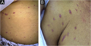 Erythematous papules on the abdomen (A) and axillary area (B).