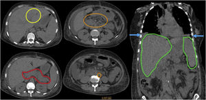 Computed tomography of the abdomen; yellow circle: intrahepatic bile duct ectasia; red circle: pancreas of heterogeneous volume and density; orange circles: enlarged intra-abdominal lymph nodes; blue arrows: bilateral pleural effusion; green circles: hepatosplenomegaly.