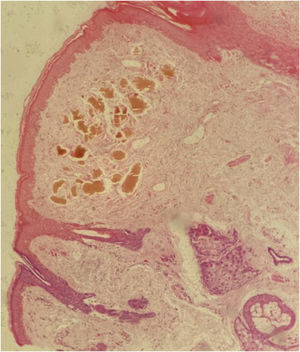 Histopathology of the skin of the left malar region revealing brownish-ocher pigmented clumps in the superficial reticular dermis and a mild interstitial and perivascular lymphohistiocytic infiltrate (Hematoxilin & eosin, 100X).