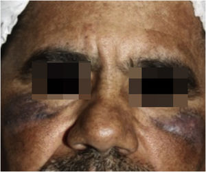 Slight improvement of lesions after the use of QS Nd:YAG 1064nm laser (Etherea; Vydence Medical) for eight sessions in toning mode (fluence between 1.0‒1.3J/cm2, 8-mm spot size and frequency of 10Hz), followed by four sessions with a fluence of 4‒5J and a spot size of 5mm.