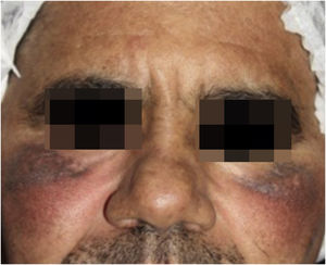 Partial response after seven sessions of Intense Pulsed Light (IPL; Etherea, Vydence Medical) using a 580nm filter, with a fluence of 15J/cm2 and a single pulse of 15ms.