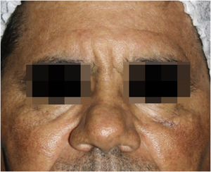 Significant lesion improvement after five sessions of fractional 10,600nm CO2 laser (Sculptor, Vydence Medical) with 120nm tip, energy between 80‒100mJ and density of 50MTZ/cm².