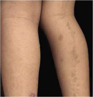 Linear lesion formed by a cluster of comedones following Blaschko's lines on the right lower limb.