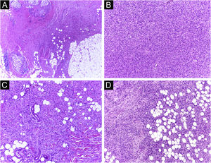 Dermatofibrosarcoma protuberans (Paraffin-embeded section, Hematoxylin & eosin). (A) (top left image): recurrent neoplasm, invading the hypodermis on the right side of the image and, on the left, an area of cicatricial fibrosis and granulomatous foreign body reaction secondary to previous conventional surgery. (B) (top right image): dense area of storiform pattern. (C and D) (bottom right and left images): infiltrative periphery of the neoplasm, with fascicles of monomorphic spindle cells, invading fibroconnective tissue on the left, and adipose tissue in both. Source: Archives of Dermatology/Pathological Anatomy HC-Unicamp.