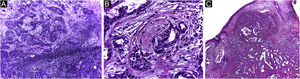 Primary cutaneous adenocarcinoma (Hematoxylin & eosin). (A) (image on the left): 5 micron-thick frozen sections, showing glandular structures infiltrating the reticular dermis, associated with chronic inflammation. (B) (center image): paraffin-embedded section showing neoplastic perineural infiltration. (C) (image on the right): paraffin-embedded section, panoramic view showing a poorly circumscribed tumor, consisting of irregular glandular structures invading the dermis. Source: Archives of Dermatology/Pathological Anatomy HC-Unicamp.