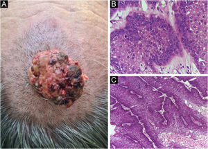 (A) Image on the left: Extraocular sebaceous carcinoma. (B) (Upper right image (paraffin-embedded section): poorly defined lobes of basaloid cells and poorly differentiated sebaceous cells. Moderate atypia. (C) (lower right image 5 micron thick frozen section): tumor debulking during Mohs micrographic surgery. Source: Archives of Dermatology HC-Unicamp.