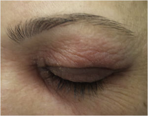 Allergic contact dermatitis caused by Kathon CG found in cosmetics.