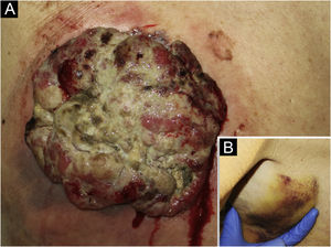(a) Exophytic multinodular tumor of 15cm in diameter with a festooned edge, white-yellowish with reddish hemorrhagic areas, surrounded by an asymmetrical erythematous halo. (b) Subcutaneous palpable mass, tough, of 5cm diameter located in left axillae.