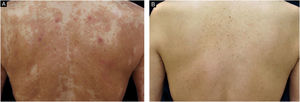 Clinical presentation of the upper back in a 65-year-old Japanese man (Case 2). (A) Pruritic lichenified plaques, papules, and prurigo nodules were present before dupilumab treatment. (B) Complete clearance of the cutaneous manifestations was achieved by 24 months after the initiation of dupilumab.