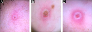 Dermatoscopic features of MKX lesions: central structureless pinkish or with brown crusting area, with white peripheral halo, circulated by pink clods and perilesional erythema, at face (A), penis (B), and perianal area (C).