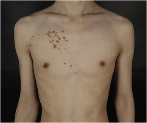 Physical examination revealed yellowish-brown firm, smooth papules, and plaques on his right chest. Distribution of the lesions followed Blaschko