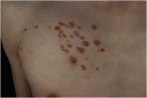 Closer look on the right chest. There is a wound after skin biopsy at the bottom.