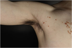 Lesions on the axilla.